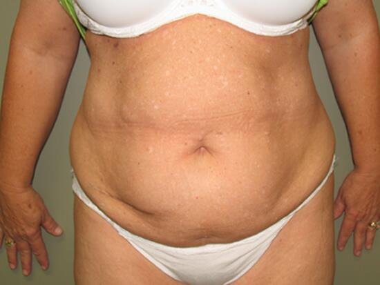 Abdominoplasty Before & After Image