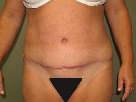 Abdominoplasty Before & After Image