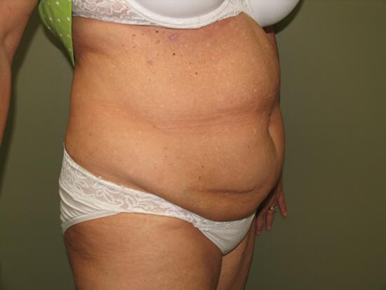 Abdominoplasty Before & After Image