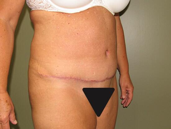 Abdominoplasty Before & After Image