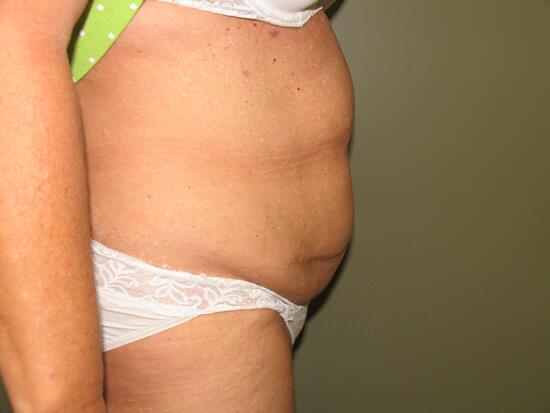 Abdominoplasty Before & After Image