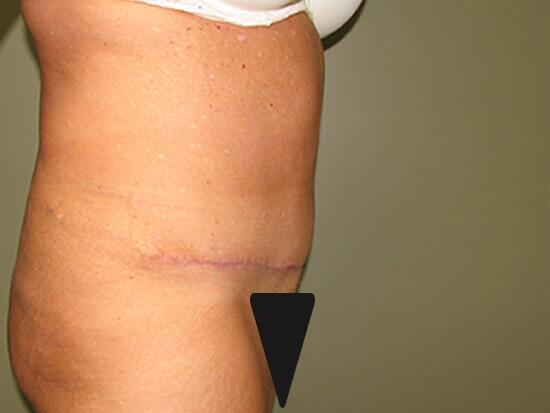 Abdominoplasty Before & After Image