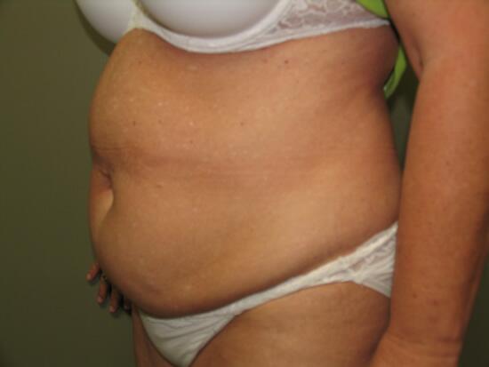 Abdominoplasty Before & After Image