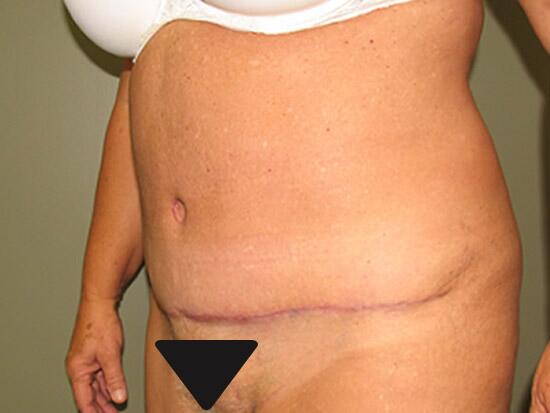 Abdominoplasty Before & After Image