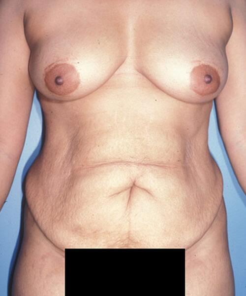 Abdominoplasty Before & After Image