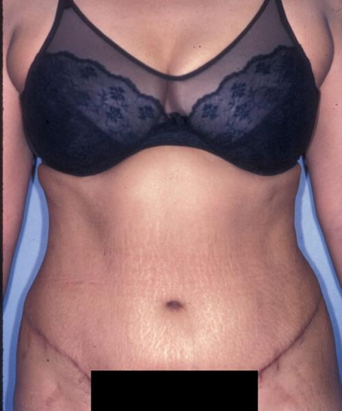 Abdominoplasty Before & After Image