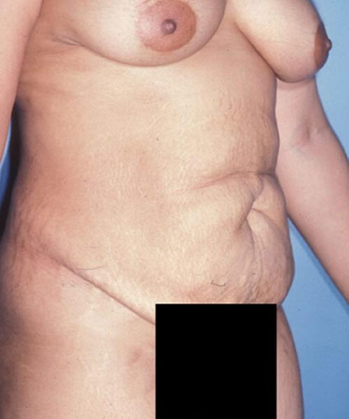 Abdominoplasty Before & After Image