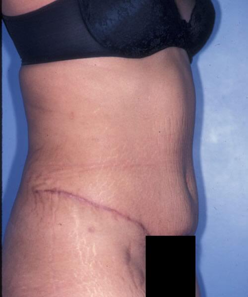 Abdominoplasty Before & After Image