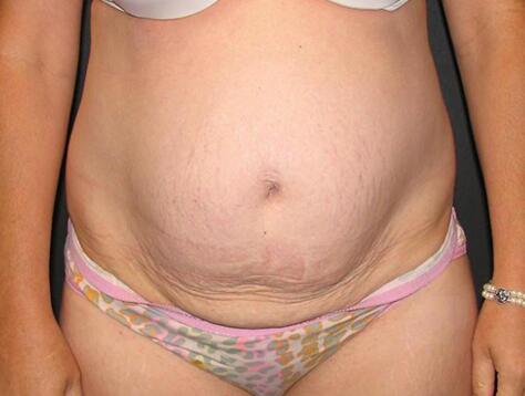 Abdominoplasty Before & After Image