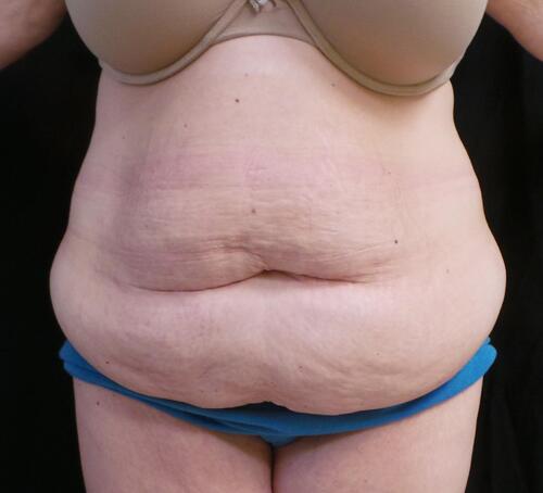 Abdominoplasty Before & After Image