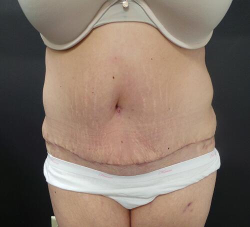 Abdominoplasty Before & After Image