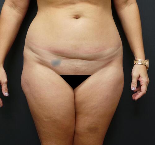 Abdominoplasty Before & After Image