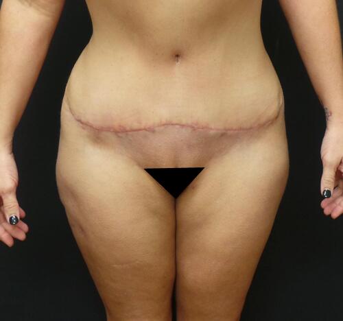 Abdominoplasty Before & After Image