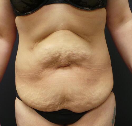 Abdominoplasty Before & After Image