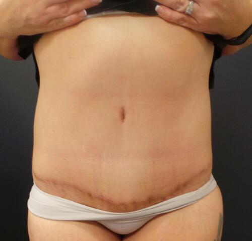 Abdominoplasty Before & After Image