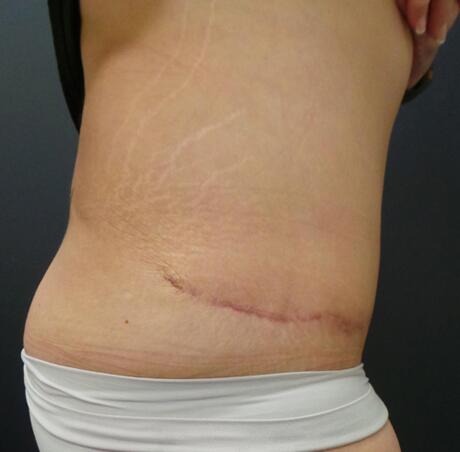Abdominoplasty Before & After Image