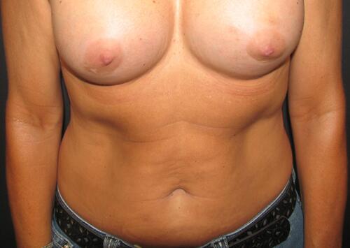 Abdominoplasty Before & After Image