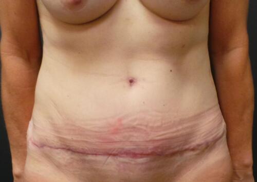 Abdominoplasty Before & After Image