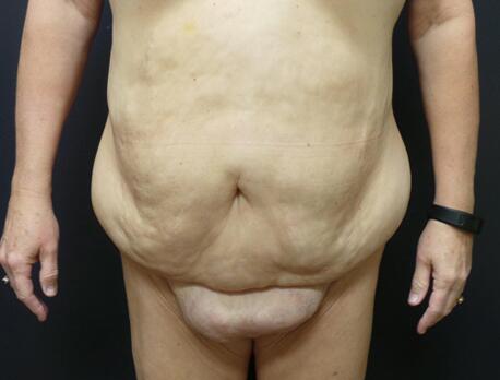 Abdominoplasty Before & After Image