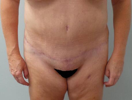 Abdominoplasty Before & After Image