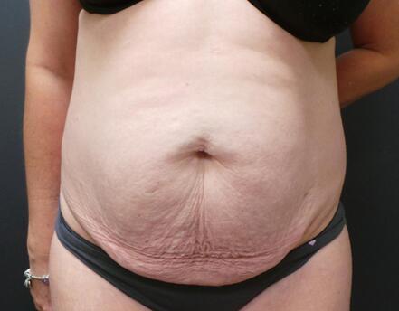 Abdominoplasty Before & After Image