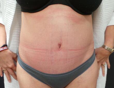 Abdominoplasty Before & After Image