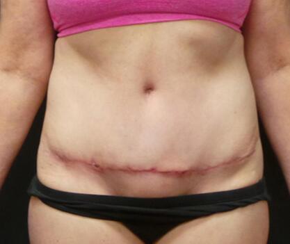 Abdominoplasty Before & After Image