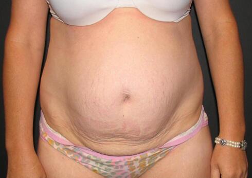 Abdominoplasty Before & After Image