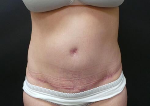 Abdominoplasty Before & After Image