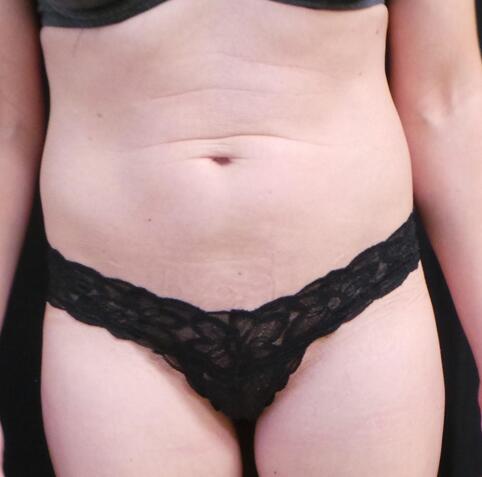 Abdominoplasty Before & After Image