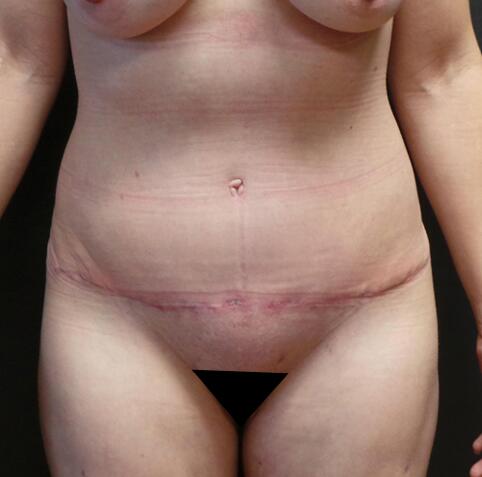 Abdominoplasty Before & After Image