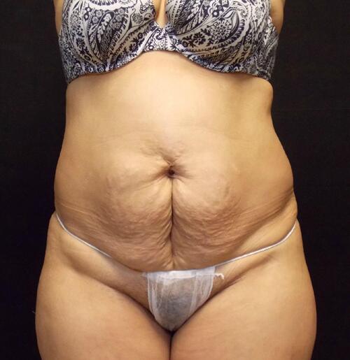 Abdominoplasty Before & After Image