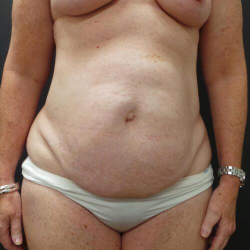 Abdominoplasty Before & After Image