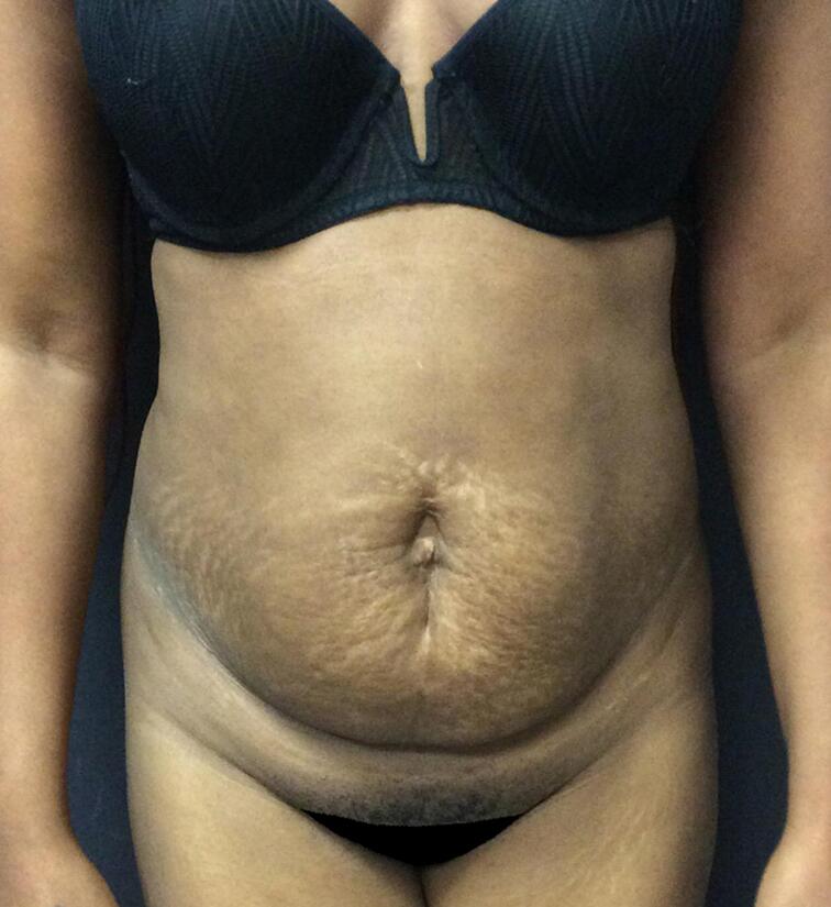 Abdominoplasty Before & After Image