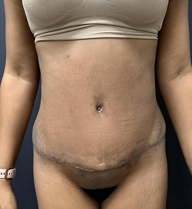 Abdominoplasty Before & After Image