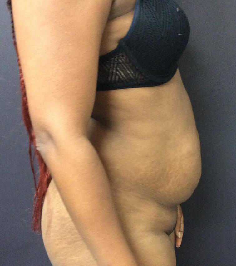 Abdominoplasty Before & After Image