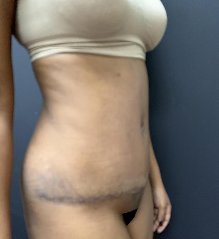 Abdominoplasty Before & After Image