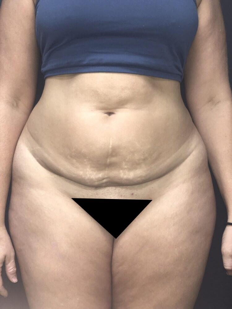 Abdominoplasty Before & After Image