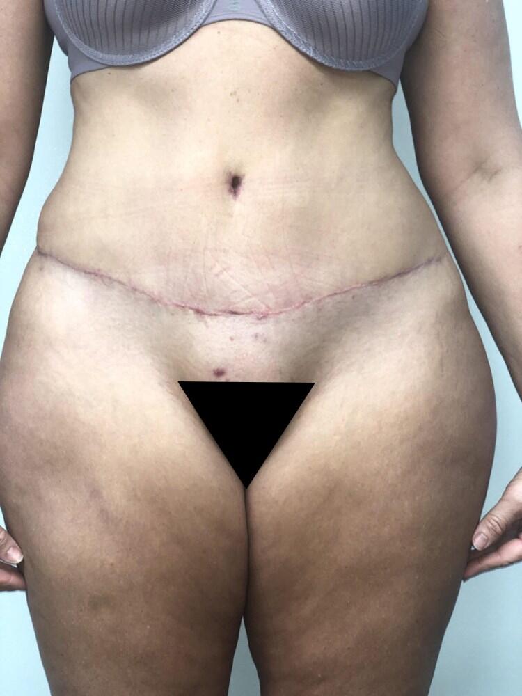 Abdominoplasty Before & After Image