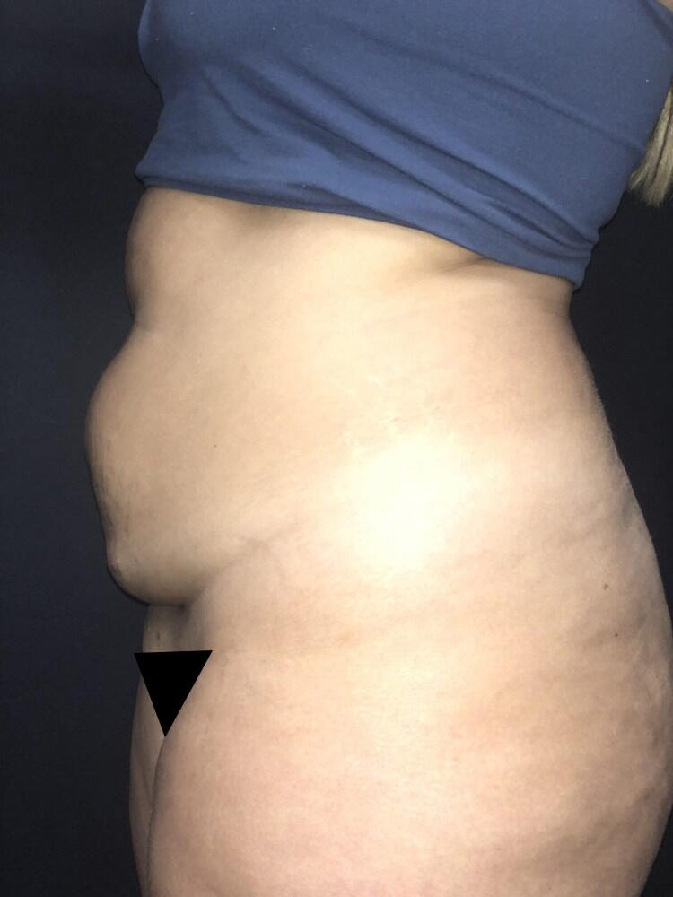 Abdominoplasty Before & After Image