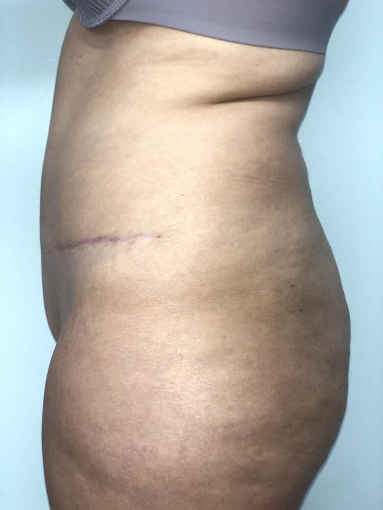 Abdominoplasty Before & After Image