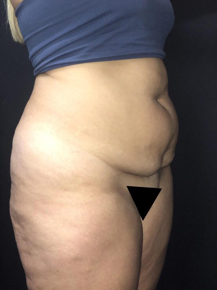 Abdominoplasty Before & After Image