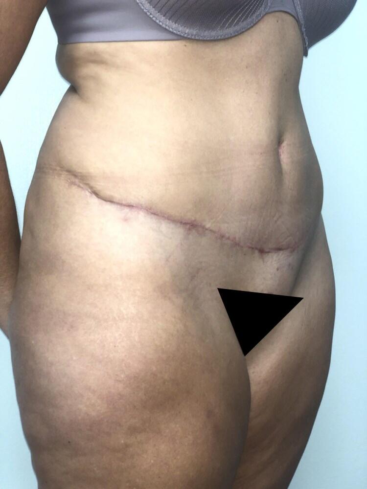 Abdominoplasty Before & After Image