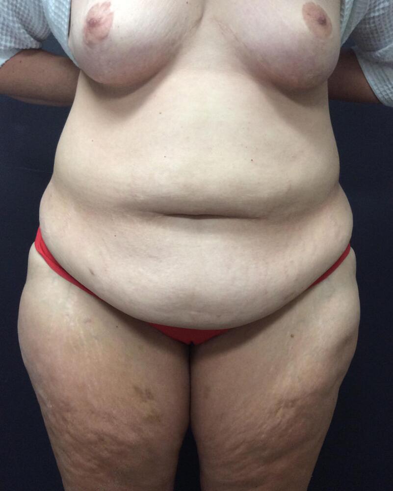 Abdominoplasty Before & After Image