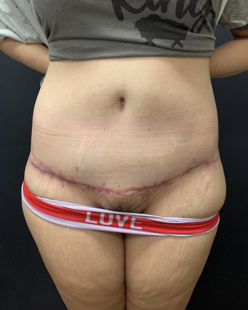 Abdominoplasty Before & After Image