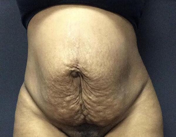 Abdominoplasty Before & After Image