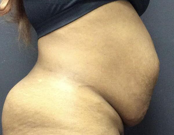 Abdominoplasty Before & After Image