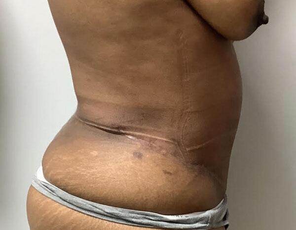 Abdominoplasty Before & After Image