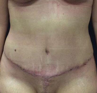 Abdominoplasty Before & After Image