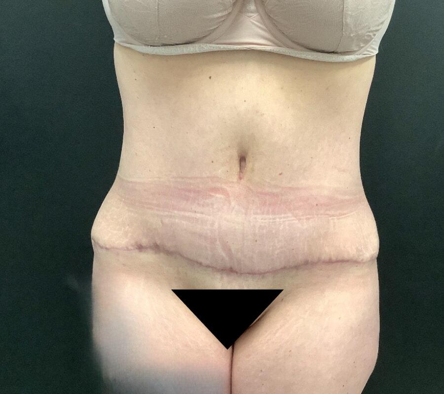 Abdominoplasty Before & After Image